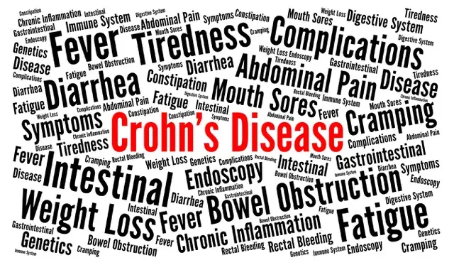 Fistulizing Crohn's, fistula